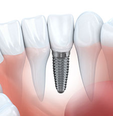 Picture of dental implants